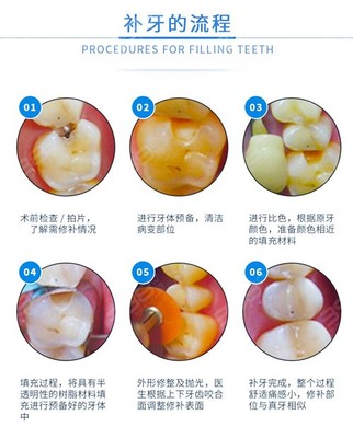 最新补牙技术，重塑牙齿健康的新里程碑